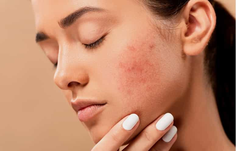 Acne Treatments VA