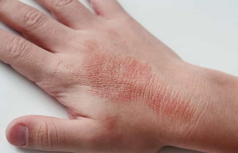 Contact Dermatitis