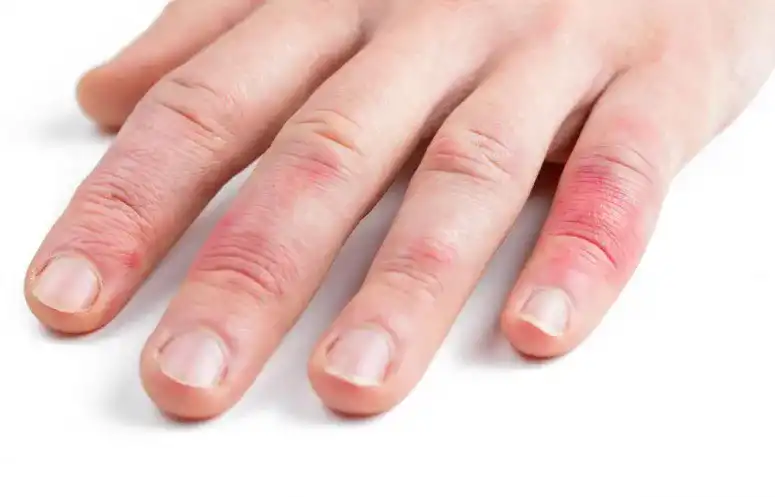 Expert Contact Dermatitis Services VA