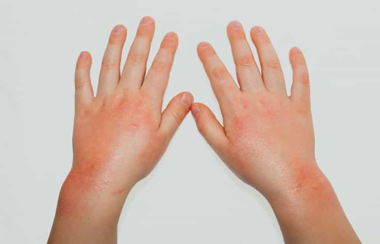 Eczema