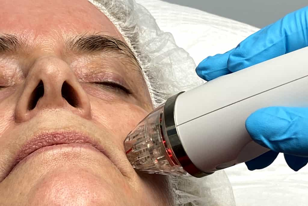 MicroNeedling Virginia