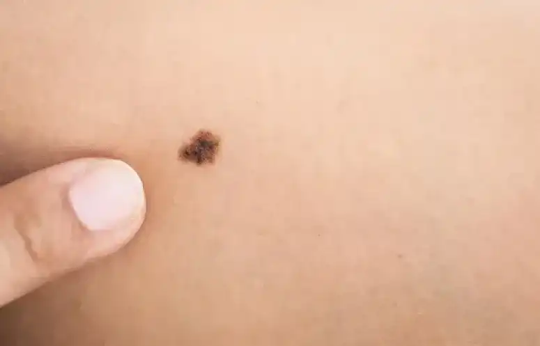 Melanoma