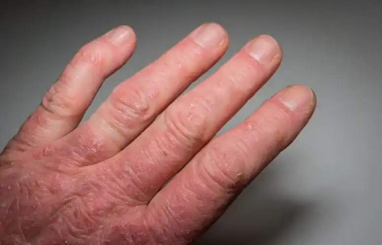 Psoriasis VA