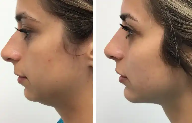 Kybella Service Virginia