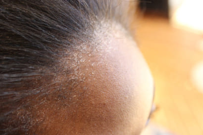 Scalp Lesions medical services